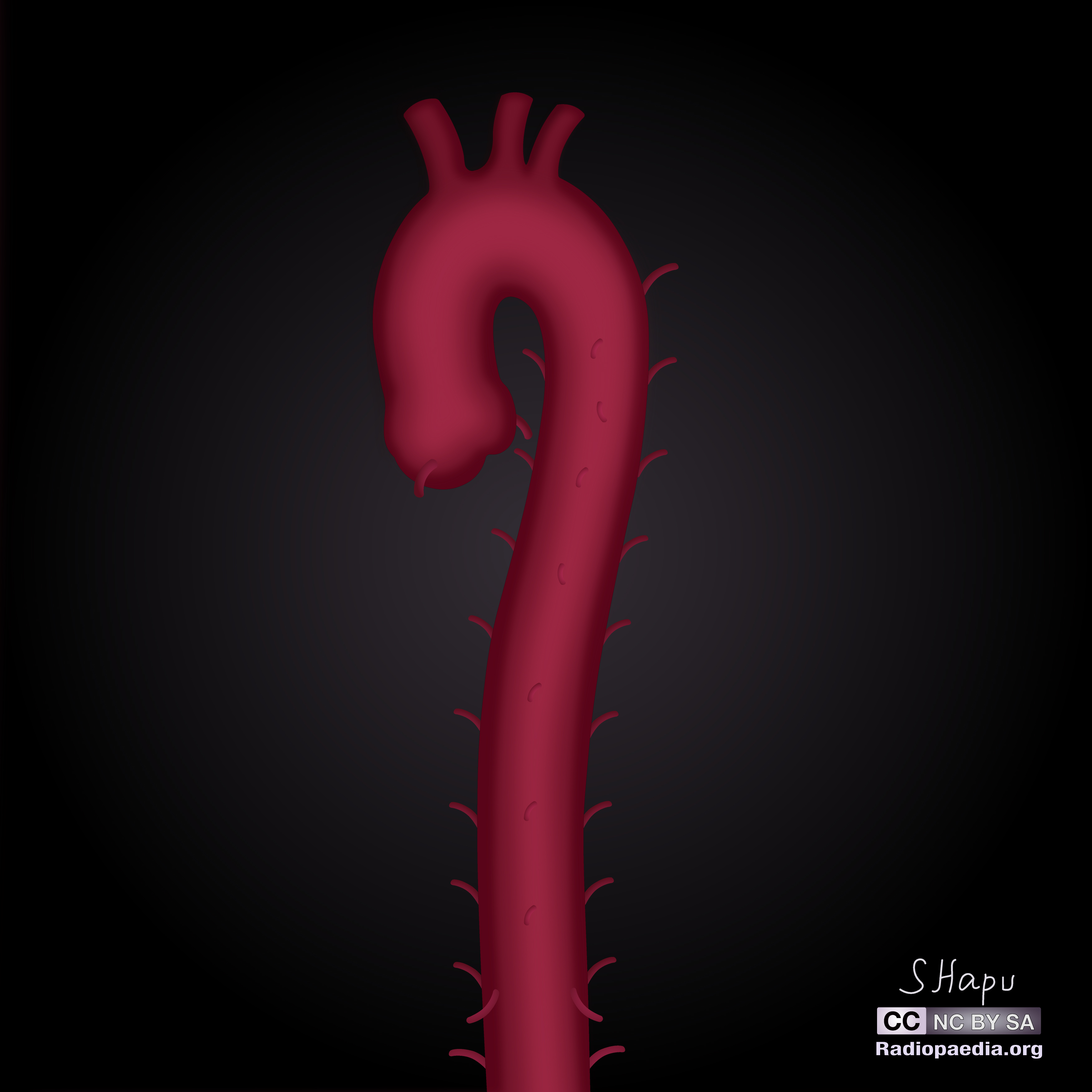 Radiopaedia Drawing Branches Of The Thoracic Aorta No Labels Anatomytool